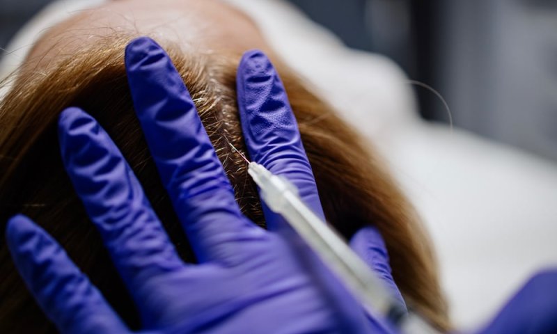 Behandler setter injeksjon i hodebunn