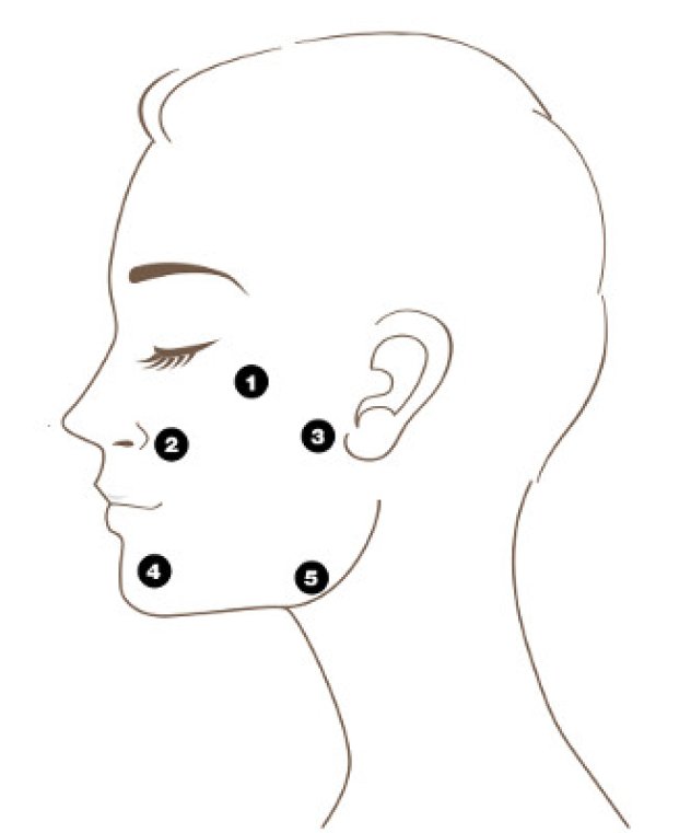 Omriss av et ansikt merket med punkter for behandling