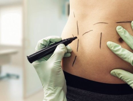Kirurg markerer med tusj på mage før operasjon