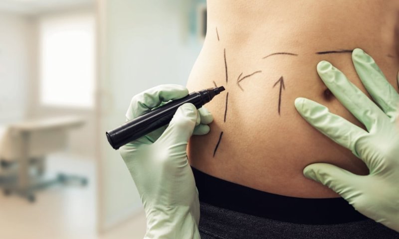 Kirurg markerer med tusj på bar mage
