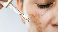 Pipette med serum på pigmentflekker i ansikt