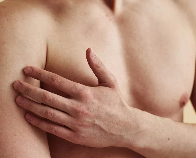 Mannlig modell for gynekomasti hos Asteta Clinic