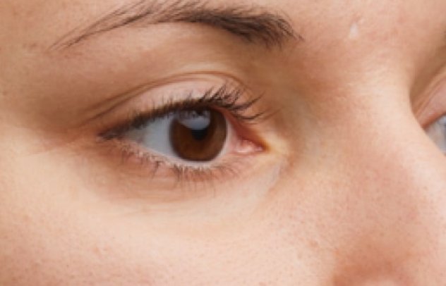 Sunekos behandling av øyeparti for mørke ringer og forbedret hudkvalitet.